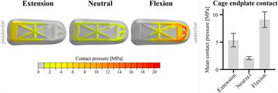 Patient-Specific Variations in Local Strain Patterns on the Surface of a Trussed Titanium Interbody Cage